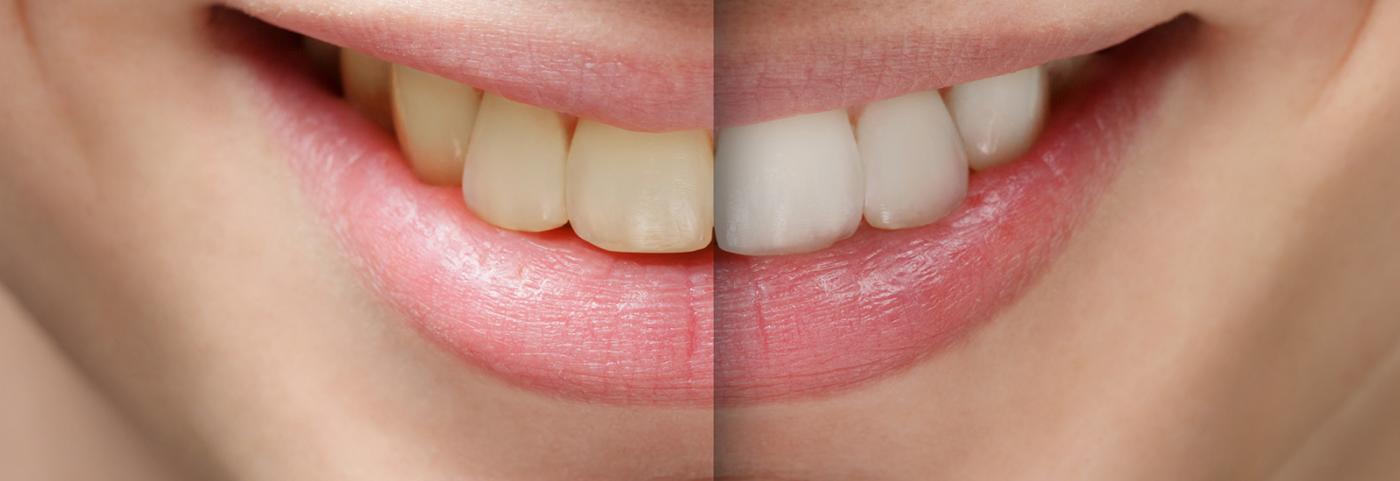 Bleaching